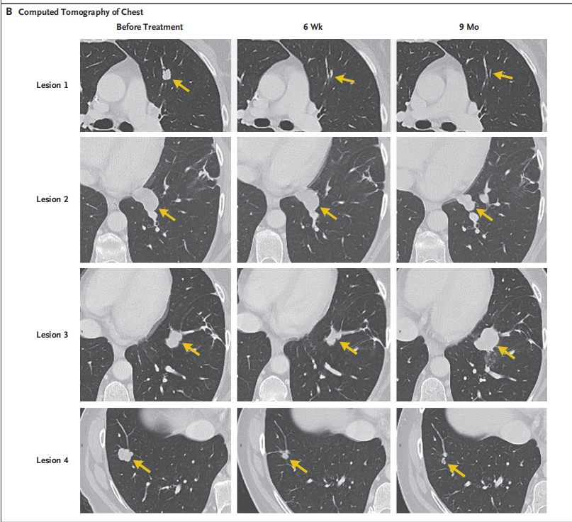 圖2?患者轉(zhuǎn)移病灶的變化情況 圖2?患者轉(zhuǎn)移病灶的變化情況
