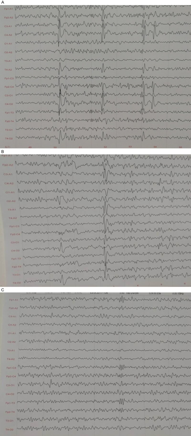 圖1:UC-MSC移植治療前后患者的腦電圖 圖1:UC-MSC移植治療前后患者的腦電圖