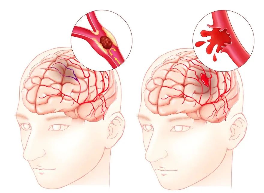 干細(xì)胞治療缺血性腦卒中的臨床試驗(yàn)