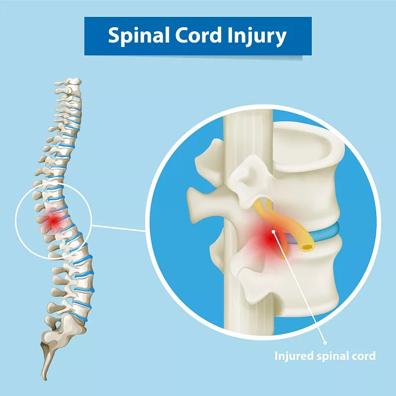 神經干/祖細胞移植治療慢性脊髓損傷的臨床研究進展 神經干/祖細胞移植治療慢性脊髓損傷的臨床研究進展