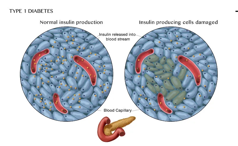 間充質干細胞在1型糖尿病治療中的作用 間充質干細胞在1型糖尿病治療中的作用
