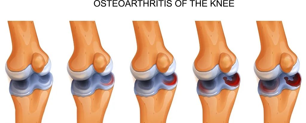 國內(nèi)外臨床研究表明:干細(xì)胞修復(fù)半月板損傷更具優(yōu)勢