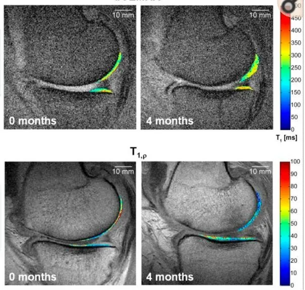 干細(xì)胞療法修復(fù)后疼痛顯著減輕,半月板軟骨質(zhì)量提高。