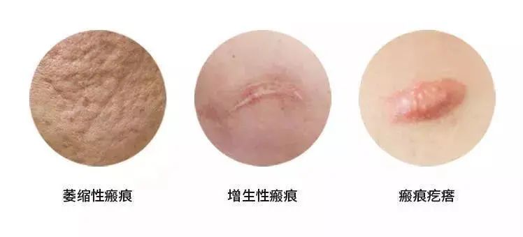 根據瘢痕的顏色、質地和形態,臨床可以將瘢痕分為三大類:萎縮性瘢痕、增生性瘢痕和瘢痕疙瘩。 根據瘢痕的顏色、質地和形態,臨床可以將瘢痕分為三大類:萎縮性瘢痕、增生性瘢痕和瘢痕疙瘩。