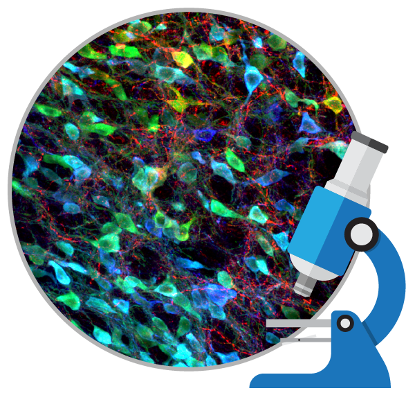 盤點:干細胞移植治療帕金森病的臨床研究進展