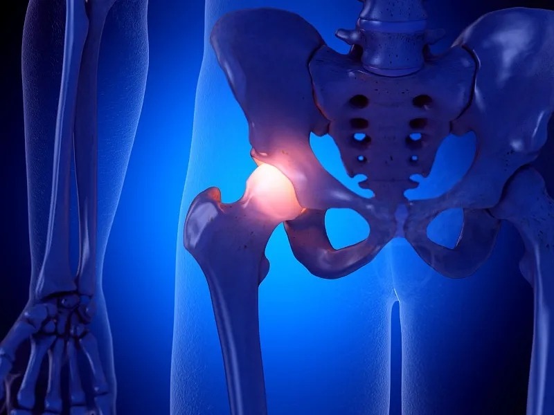 西班牙薩拉曼卡醫院:干細胞治療股骨頭壞死I/II期臨床試驗的長期結果