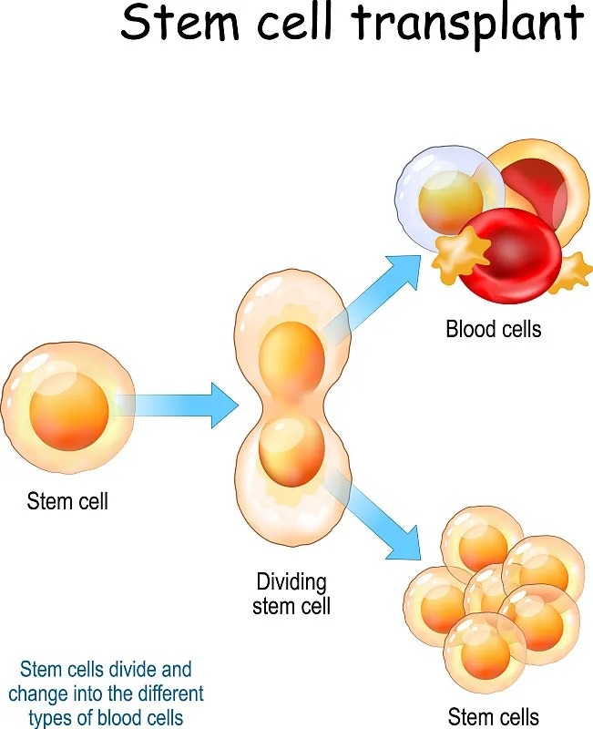 干細胞移植的五個階段是什么 干細胞移植的流程分為那五個階段