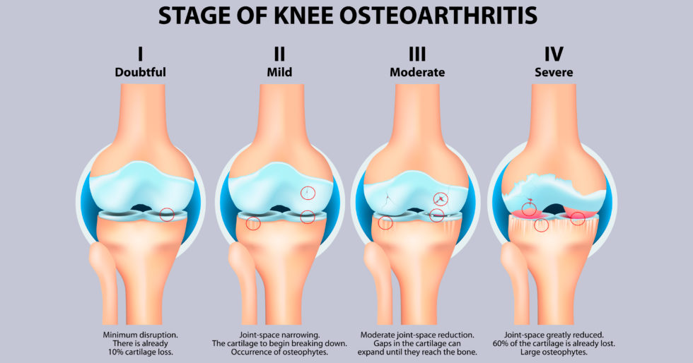 骨關節(jié)炎癥狀有哪些 骨關節(jié)炎癥狀有哪些