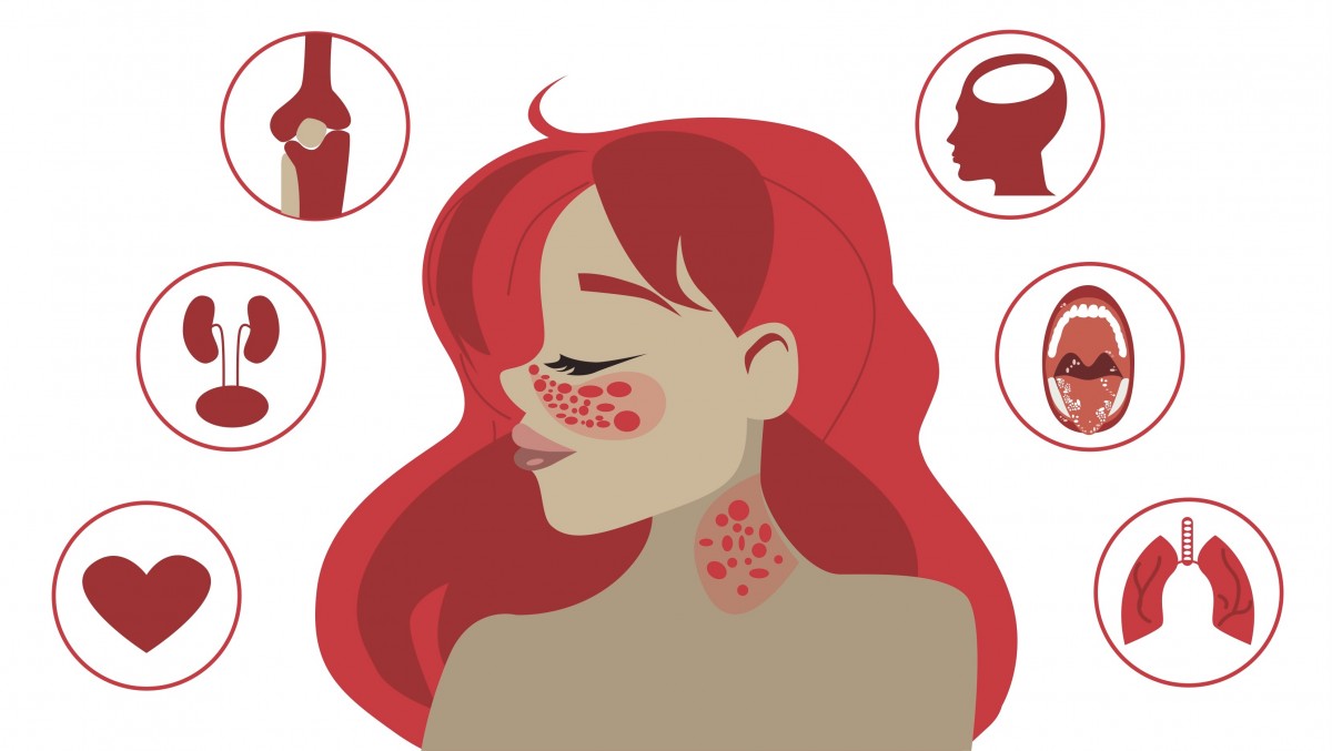 系統(tǒng)性紅斑狼瘡的癥狀是什么 系統(tǒng)性紅斑狼瘡的癥狀是什么