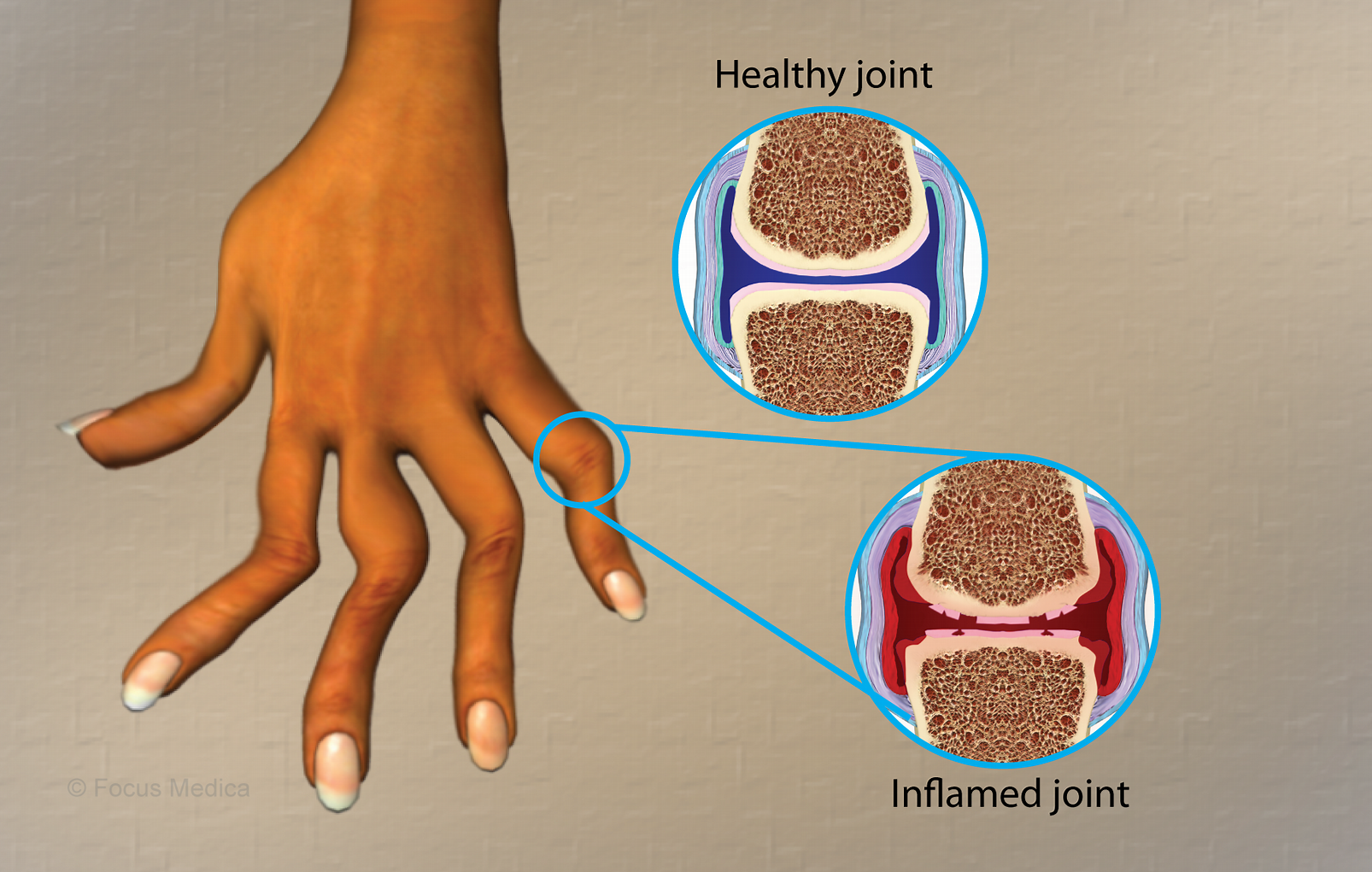 類風濕關節(jié)炎是什么病