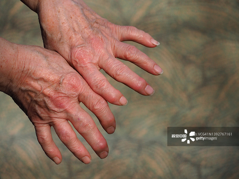 研究為治療類風濕性關節炎開辟了新的治療途徑