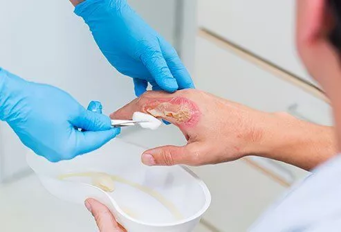 燒傷的癥狀 燒傷的癥狀