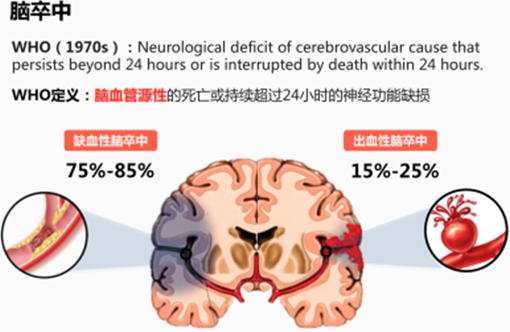 干細胞治療缺血性腦卒中的效果跟給藥途徑有關嗎