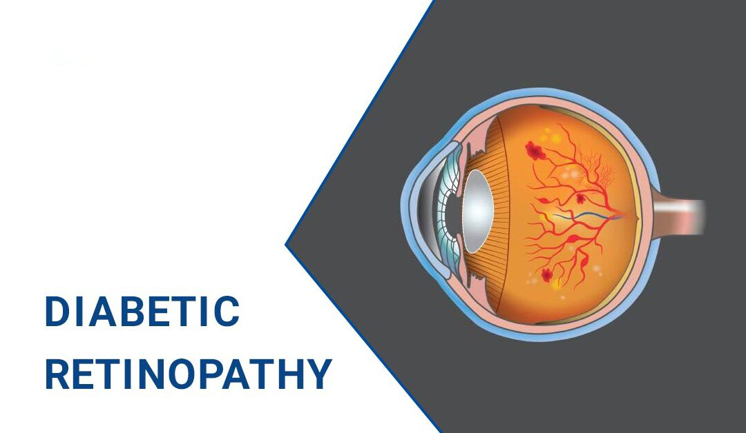 糖尿病視網膜病變–原因、階段和治療 糖尿病視網膜病變–原因、階段和治療
