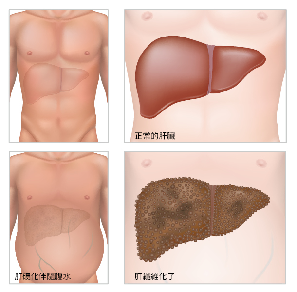 干細(xì)胞移植作為中國人群肝硬化的輔助治療策略-:有效性和安全性的薈萃分析 干細(xì)胞移植作為中國人群肝硬化的輔助治療策略-:有效性和安全性的薈萃分析