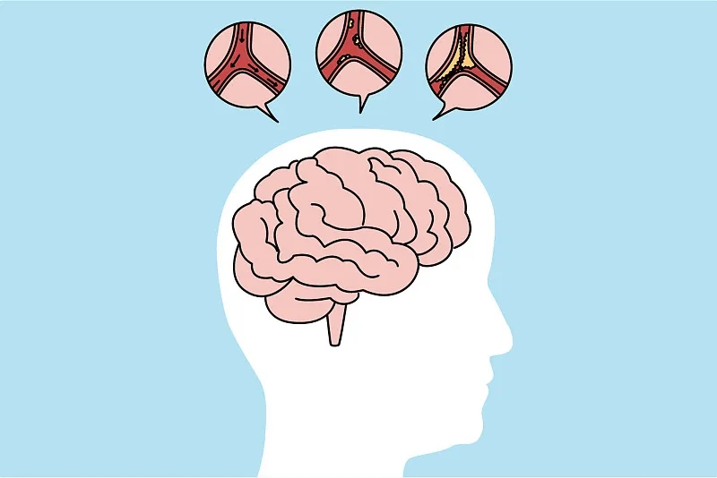 通過比較6、12、24個月的結果，來評估干細胞治療缺血性中風的有效性和安全性