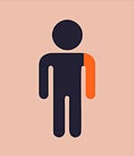 單癱型腦癱影響一側肢體，通常是手臂。