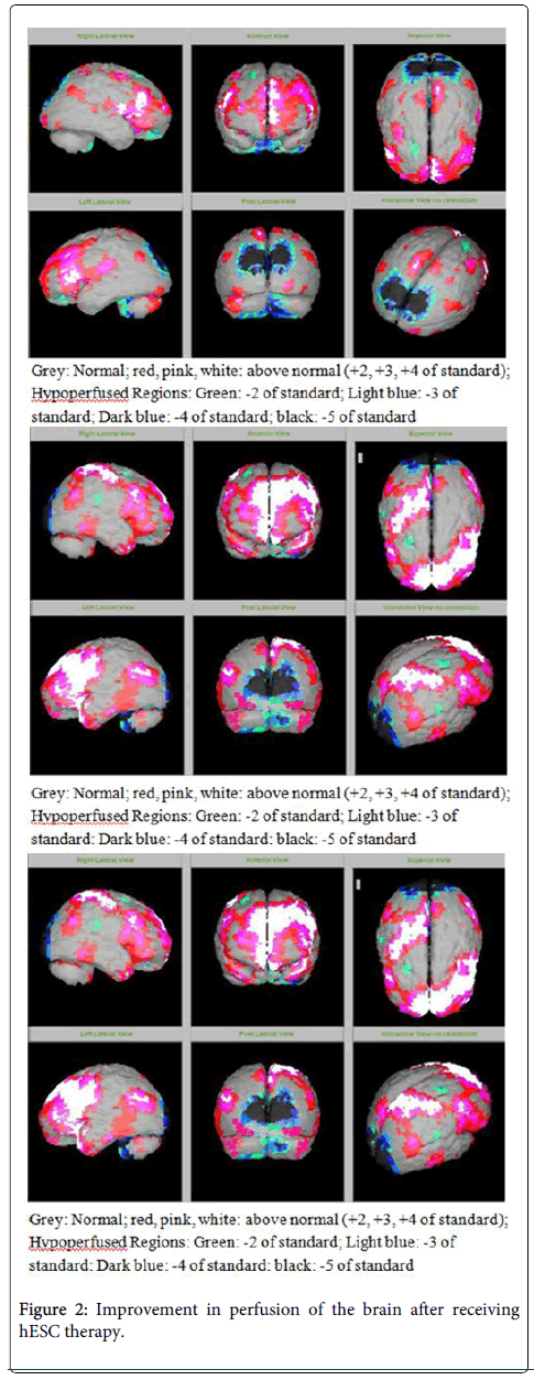 圖2:接受hESC治療后大腦灌注得到改善 圖2:接受hESC治療后大腦灌注得到改善