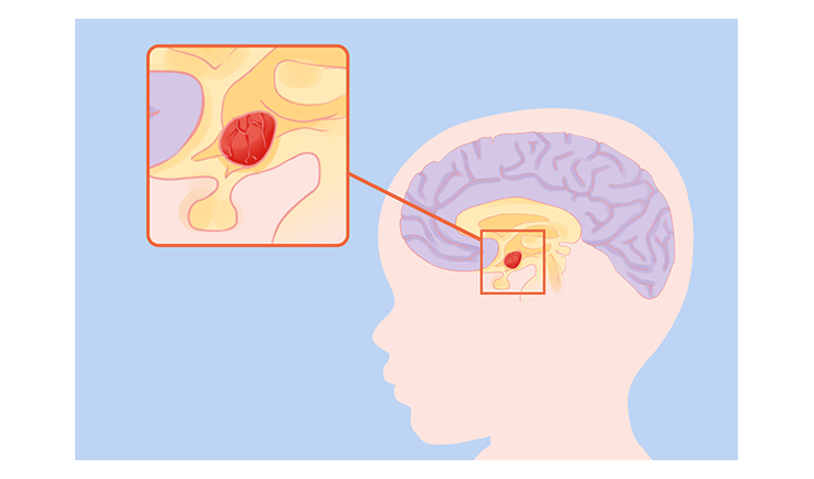 干細胞治療腦癱的成功率是多少？