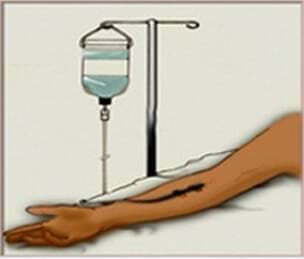 靜脈注射圖像。