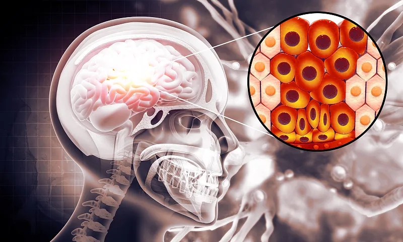 羊膜細胞療法治療缺血性中風患者的I期試驗結果 羊膜細胞療法治療缺血性中風患者的I期試驗結果