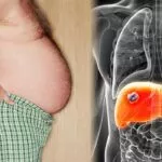 肝損傷警告信號(hào)——腹部腫脹 肝損傷警告信號(hào)——腹部腫脹