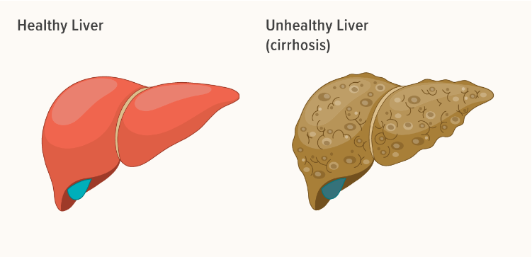 導(dǎo)致肝臟疾病的問(wèn)題及其原因 導(dǎo)致肝臟疾病的問(wèn)題及其原因