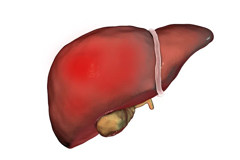 什么是丁型肝炎? 什么是丁型肝炎?