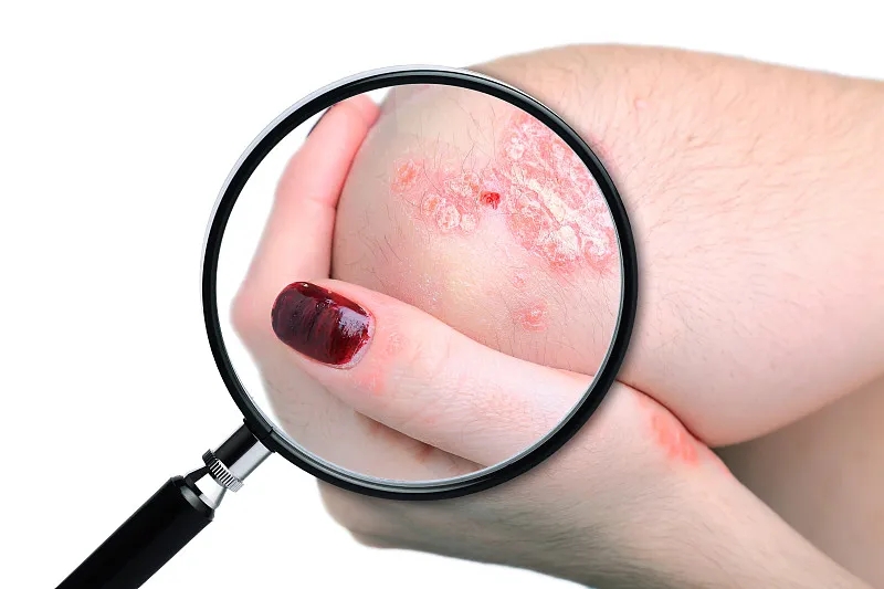 國內已有7項臨床研究項目,干細胞治療銀屑病,未來可期! 國內已有7項臨床研究項目,干細胞治療銀屑病,未來可期!