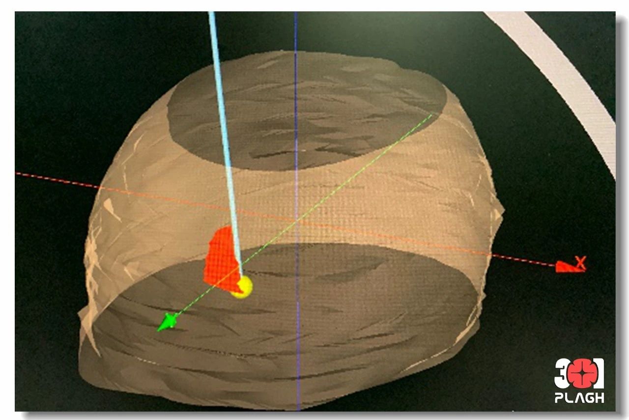術(shù)前定路徑 術(shù)前定路徑