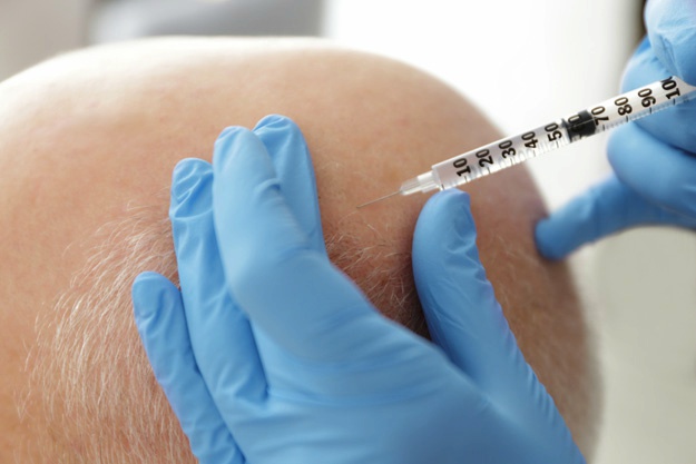 頭發修復過程是怎樣的？ |  干細胞治療脫發