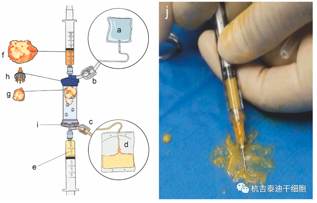 圖1:Lipogems?裝置和自體微碎片脂肪組織