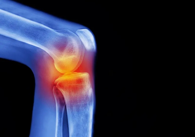 骨關(guān)節(jié)炎——間充質(zhì)干細胞在軟骨再生中的作用 骨關(guān)節(jié)炎——間充質(zhì)干細胞在軟骨再生中的作用