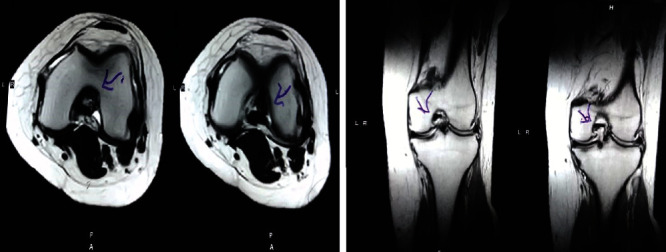 圖2:治療后MRI顯示內側和外側半月板后角的撕裂有所改善。患者經歷了癥狀改善以及進行日常生活活動的能力增強。 圖2:治療后MRI顯示內側和外側半月板后角的撕裂有所改善。患者經歷了癥狀改善以及進行日常生活活動的能力增強。