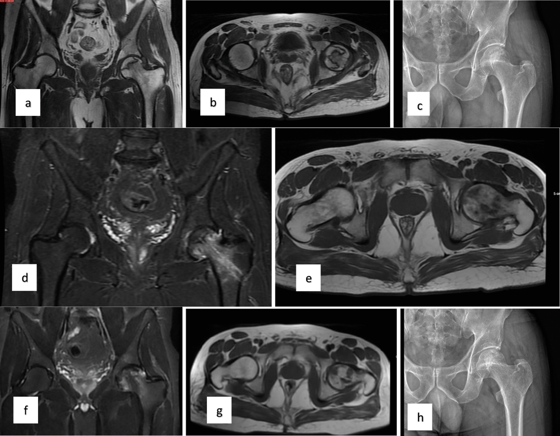 對患者的術前、3個月、6個月、1年和2年隨訪進行評估(圖1)。 對患者的術前、3個月、6個月、1年和2年隨訪進行評估(圖1)。