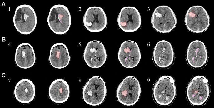 圖1:每個(gè)間充質(zhì)干細(xì)胞治療患者按組的原始非對(duì)比計(jì)算機(jī)斷層掃描和分割結(jié)果 圖1:每個(gè)間充質(zhì)干細(xì)胞治療患者按組的原始非對(duì)比計(jì)算機(jī)斷層掃描和分割結(jié)果