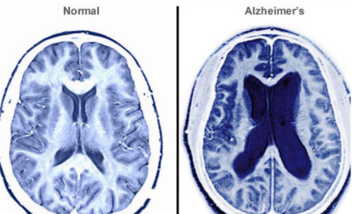 干細胞治療阿爾茲海默癥機制分2種途徑 干細胞治療阿爾茲海默癥機制分2種途徑