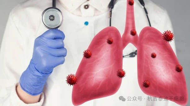 干細胞療法如何減緩肺部疾病的癥狀? 干細胞療法如何減緩肺部疾病的癥狀?