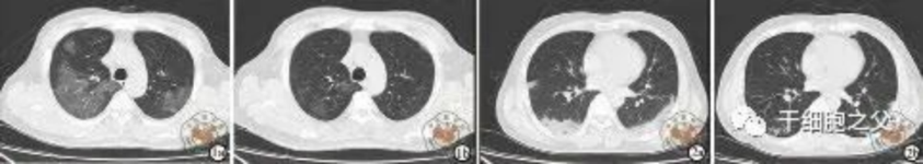 細胞輸注后,炎癥指標改善,復查胸部CT提示雙肺病灶較前吸收,呼吸道癥狀改善,新型冠狀病毒核酸檢測連續(xù)2次陰性,治愈出院。 細胞輸注后,炎癥指標改善,復查胸部CT提示雙肺病灶較前吸收,呼吸道癥狀改善,新型冠狀病毒核酸檢測連續(xù)2次陰性,治愈出院。