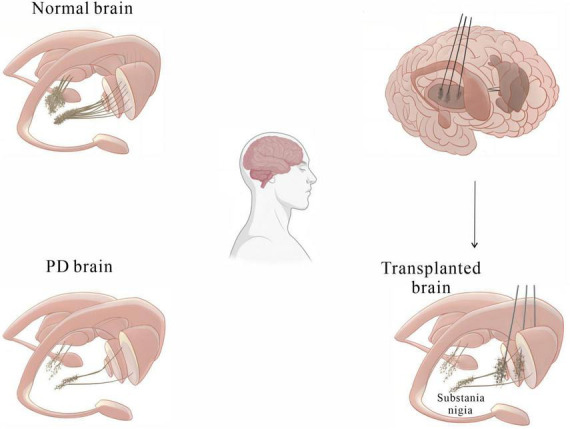 圖2:基本圖顯示細胞移植療法如何緩解帕金森病患者的運動癥狀。 圖2:基本圖顯示細胞移植療法如何緩解帕金森病患者的運動癥狀。