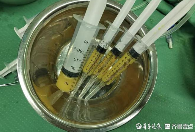 孫濤主任采用的自體脂肪微片段治療術(shù),為她的治療帶來了新的轉(zhuǎn)機(jī) 孫濤主任采用的自體脂肪微片段治療術(shù),為她的治療帶來了新的轉(zhuǎn)機(jī)