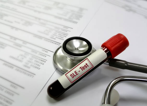 臍帶干細胞可以幫助狼瘡患者嗎？