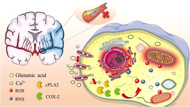 高血壓、高脂血癥、高同型半胱氨酸血癥、高血糖、吸煙和酗酒等危險因素都可能引發缺血性中風的發生。