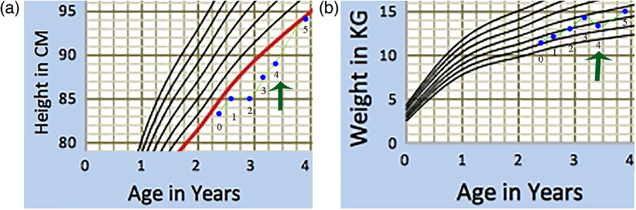圖1：一名患有嚴(yán)重III型OI的男孩的生長(zhǎng)曲線圖。