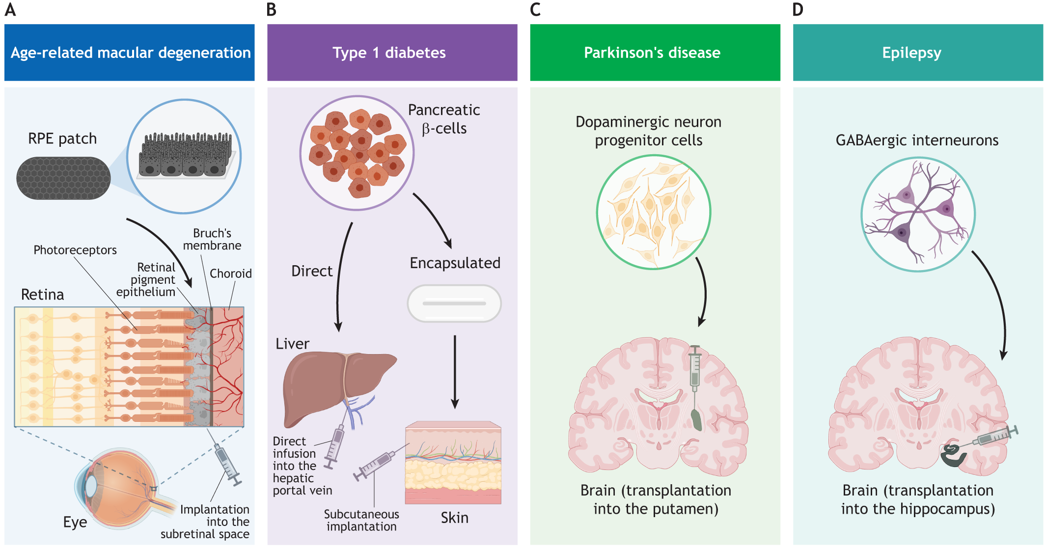 圖2:使用hPSC衍生細胞產品進行開創性臨床試驗時所涉及的細胞類型和注射部位的圖示。 圖2:使用hPSC衍生細胞產品進行開創性臨床試驗時所涉及的細胞類型和注射部位的圖示。