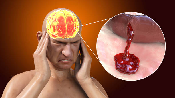 了解缺血性中風(fēng)的病理生理學(xué):當(dāng)前療法的基礎(chǔ)和干細(xì)胞療法的機(jī)遇 了解缺血性中風(fēng)的病理生理學(xué):當(dāng)前療法的基礎(chǔ)和干細(xì)胞療法的機(jī)遇