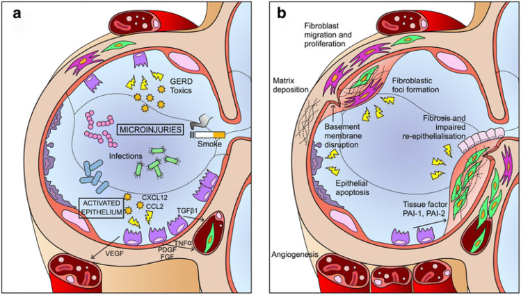 圖1：IPF發病機制示意圖。