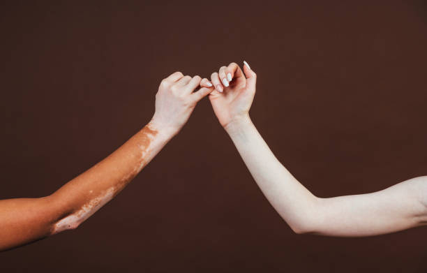 干細胞轉換醫學雜志：干細胞治療難治性白癜風安全有效