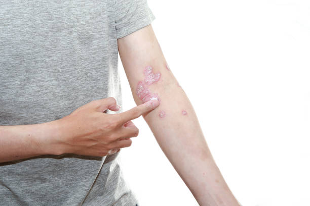 預防銀屑病發(fā)作的10個技巧，你都了解嗎？