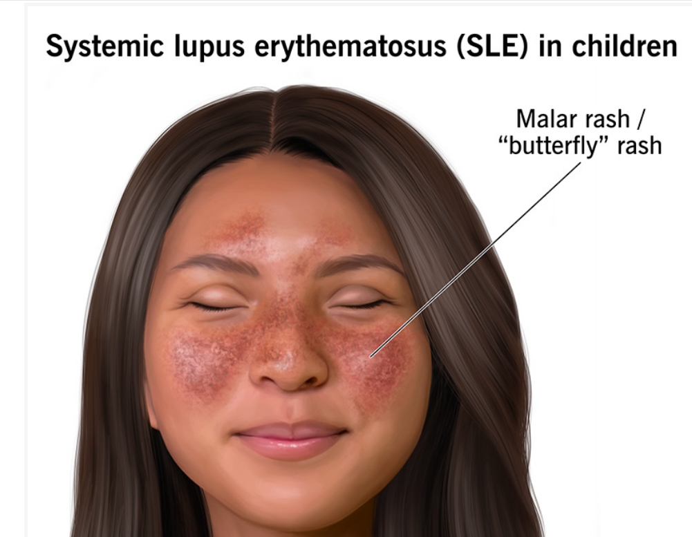 什么是兒童系統(tǒng)性紅斑狼瘡?及其病因和治療方法 什么是兒童系統(tǒng)性紅斑狼瘡?及其病因和治療方法